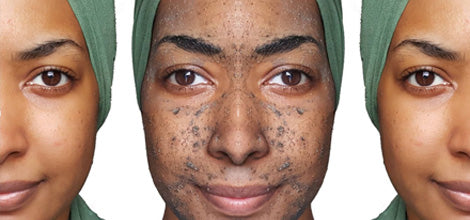 5 Things You Should Know Before Getting a Chemical Peel